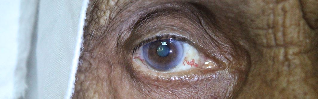 Cataracts – the symptoms, causes, and treatment